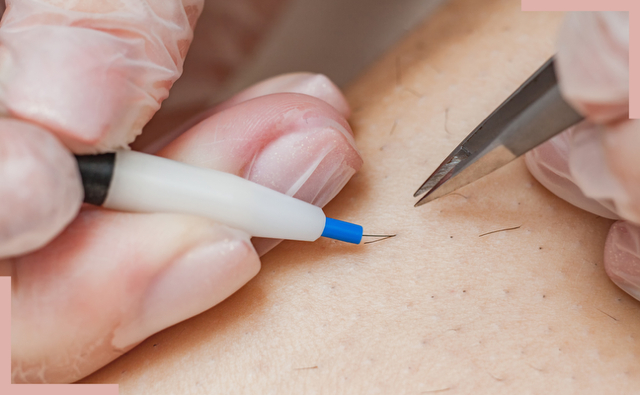 Transgender Hair Removal 4